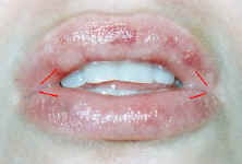 lip augmentation scar and incision photo
